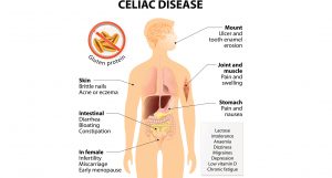 Celiac Disease chart