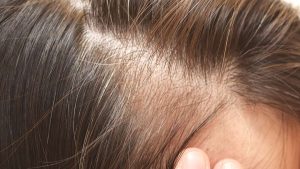 scalp with thinning hair